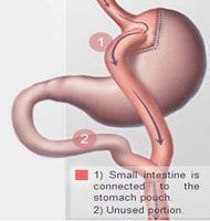 Roux En Y Gastric Bypass Patient Story India| Weight Loss Surgery Patient Reviews India