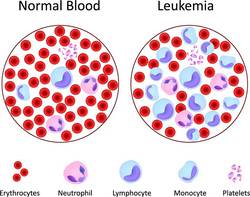 Bone marrow transplant India