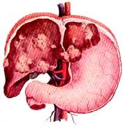 Liver transplant India