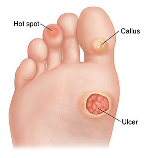 diabetic foot surgery