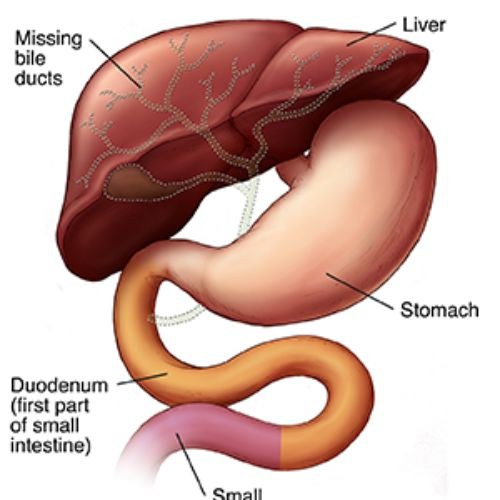 Blocked Bile Duct Treatment in India