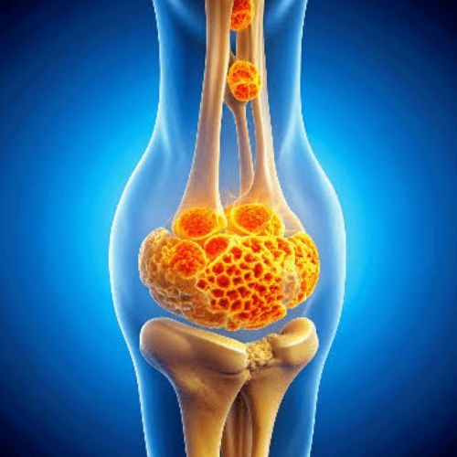 Bone Cancer Surgery in India