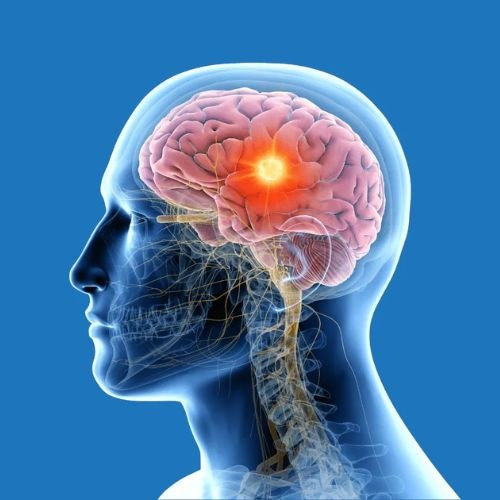 Affordable Cost Brain Cancer Surgery in India