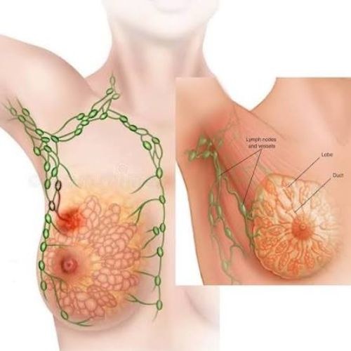 Low Cost Breast Cancer Treatment and Surgery in India