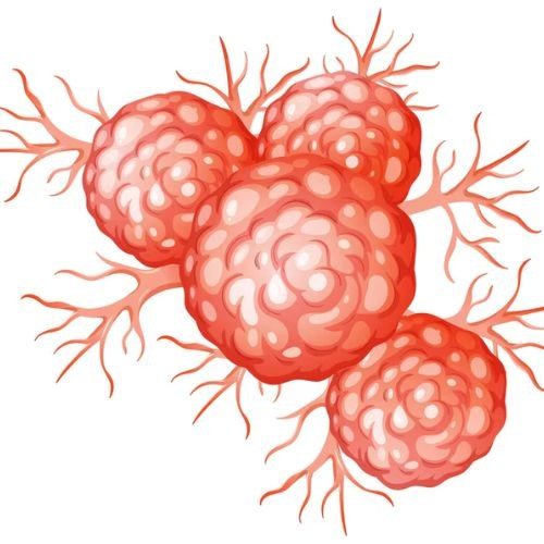 Cancer Surgery in India at Affordable Cost