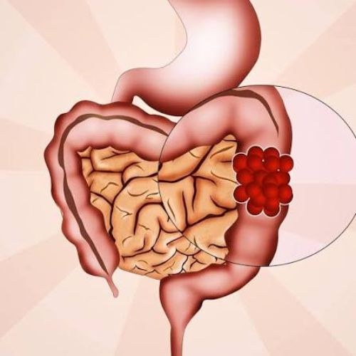 Colon Cancer Surgery in India at Low Cost