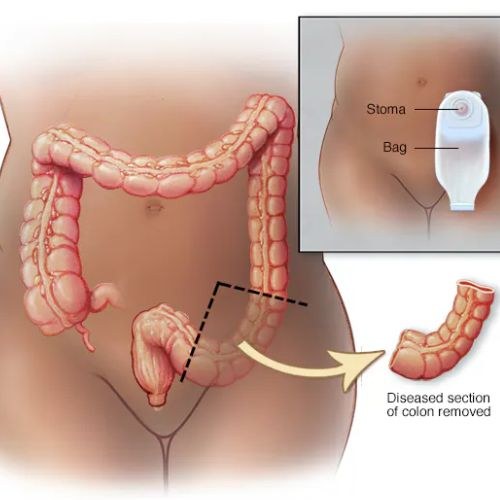 What is Colon Cancer?