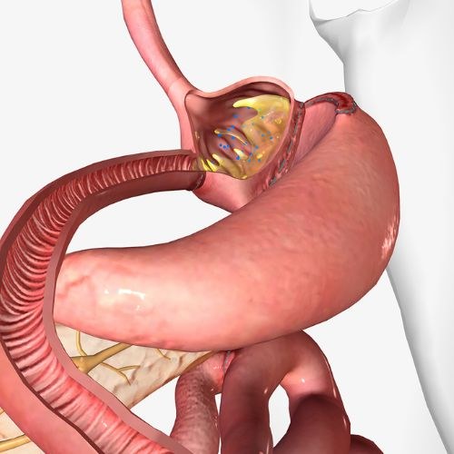 Gastric Bypass Surgery in India