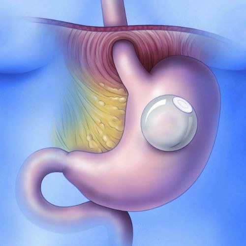 Low Cost Intragastric balloon surgery in India