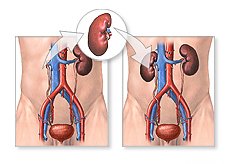 What is Kidney Transplantation?