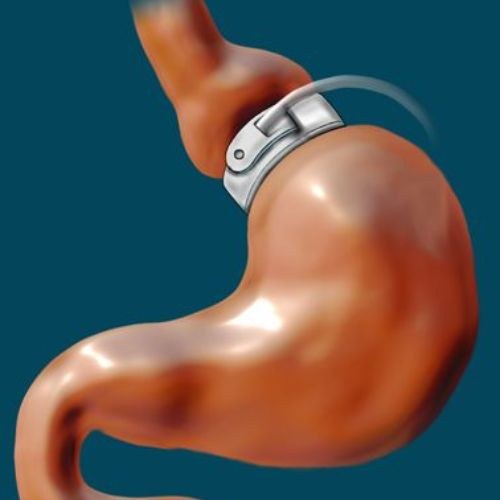 Lap Band Surgery in India