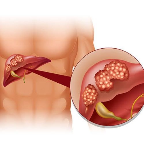 Liver Cancer Treatment and-Surgery in India