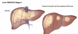 Staging of Liver Cancer