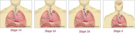 Types of Lung Cancer Surgery