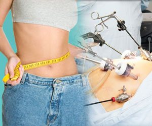 Obesity Surgery in India at Affordable Cost