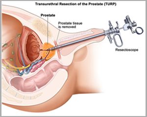 Plan your Prostate Cancer Treatment and Surgery