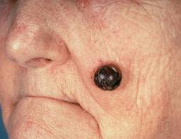 Types of Skin Cancer